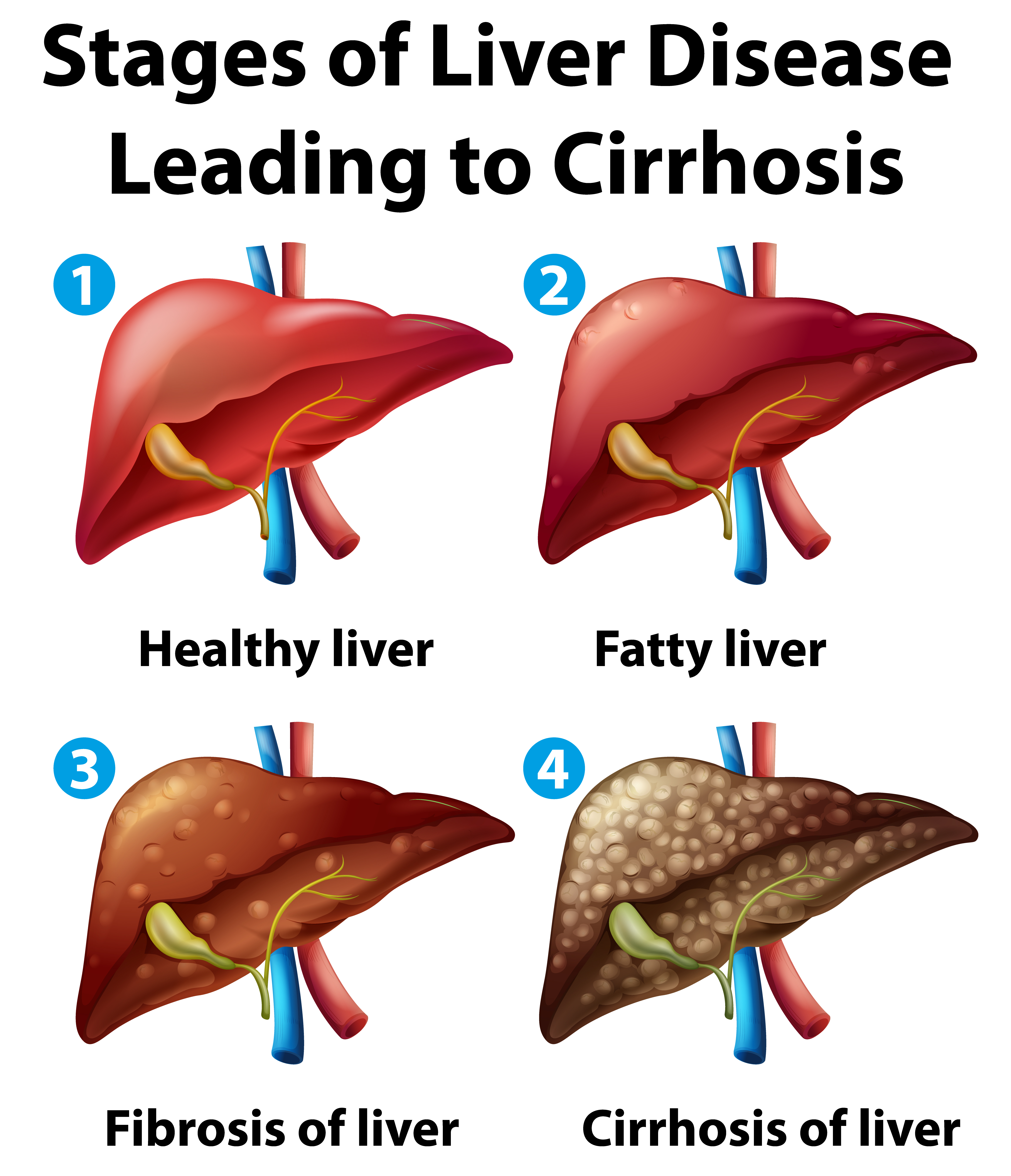 Stages of liver disease leading to Cirrhosis